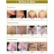 Alexandrite Long Pulse Laser 755nm 1064nm GENTAL MAX PRO laser hair removal machine