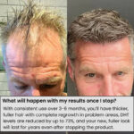 Dr Medsam hair regrowth microneedle serum for dermaroller - Image 6